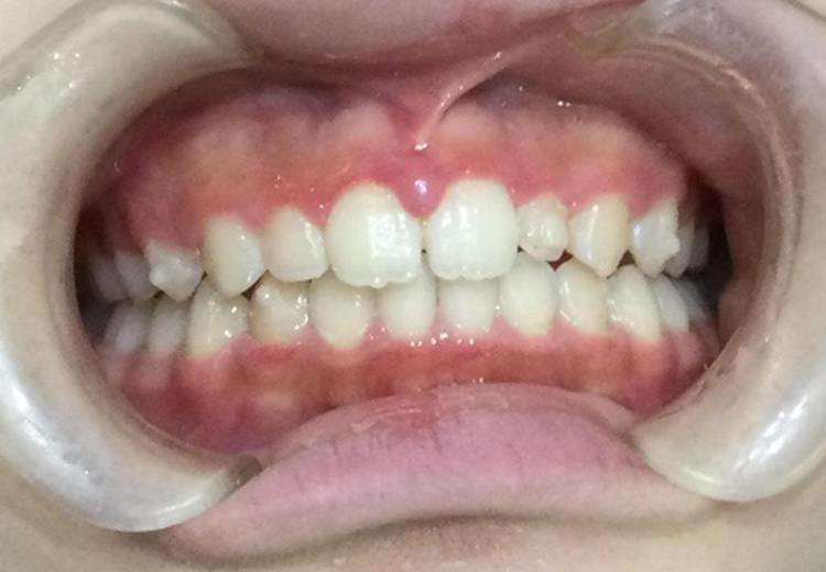 こさか歯科クリニックの症例
